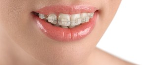 Post: Why Choose Clear Aligners or Braces for a Straighter Smile? Post: Why Choose Clear Aligners or Braces for a Straighter Smile?