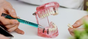 Post: Transform Your Smile with Dental Implants from KA Dental in West Palm Beach Post: Transform Your Smile with Dental Implants from KA Dental in West Palm Beach