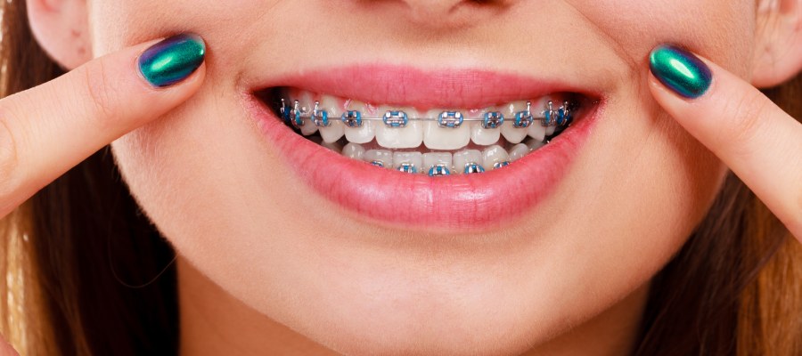 Post: Dr. Aditi Patel Shares Subtle Signs You Might Be Skipping Your Orthodontic Duties Post: Dr. Aditi Patel Shares Subtle Signs You Might Be Skipping Your Orthodontic Duties