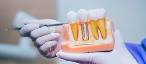 Post: Navigating the Choice Between Dental Implants and Bridges Post: Navigating the Choice Between Dental Implants and Bridges