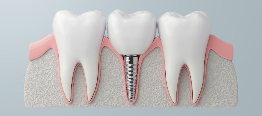 Post: West Palm Beach's Leading Dental Implant Office – KA Dental Post: West Palm Beach's Leading Dental Implant Office – KA Dental