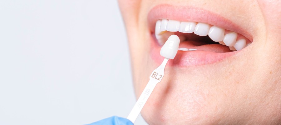 Post: Teeth Whitening Costs and Options: Which Treatment is Right for You?