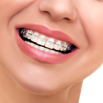 Braces Near Me in Royal Palm Beach, West Palm Beach, Palm Beach Gardens, and Lantana, FL