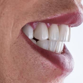 Cosmetic Crowns Near Me in Royal Palm Beach, West Palm Beach, Palm Beach Gardens, and Lantana, FL