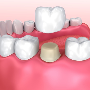 Dental Crowns Near Me in Royal Palm Beach, West Palm Beach, Palm Beach Gardens, and Lantana, FL