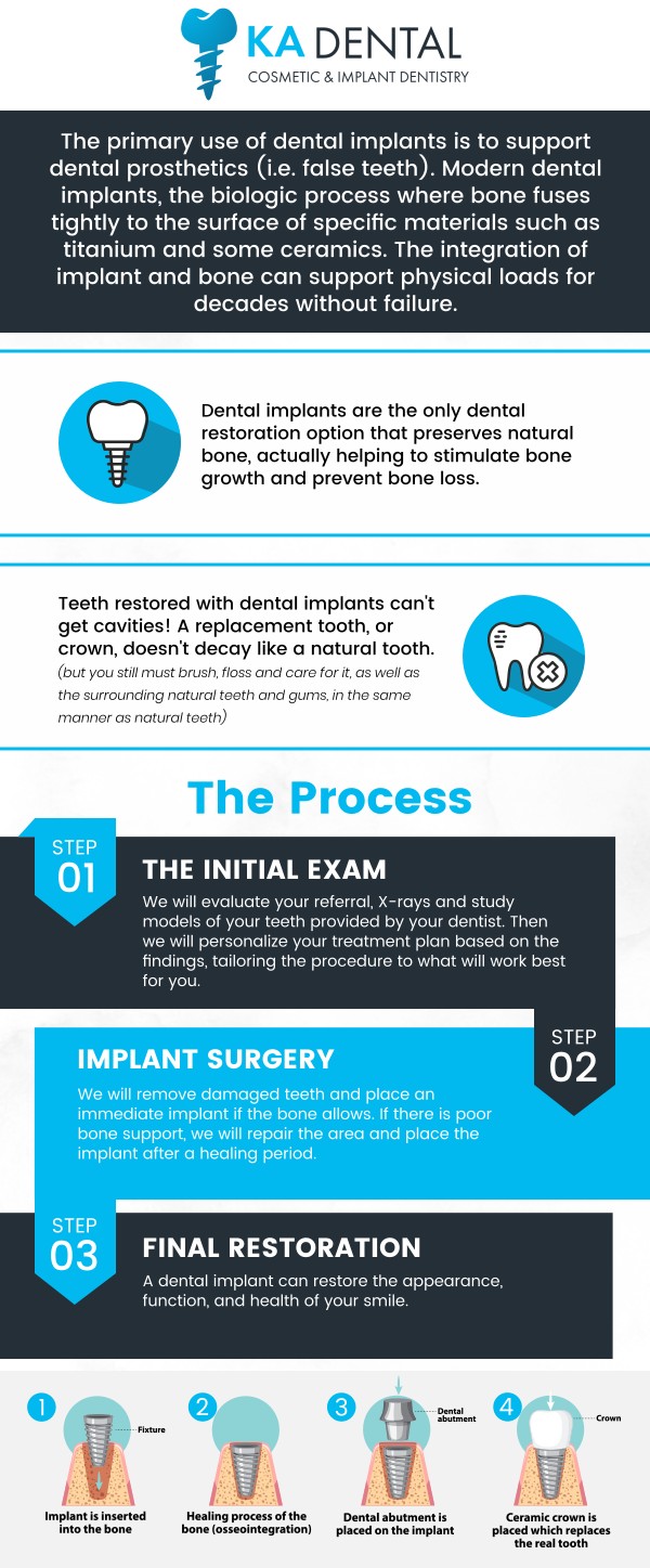 Dental implants are a durable, long-term solution for replacing missing teeth, offering both a functional and aesthetic improvement. They provide a stable foundation for replacement teeth, improving chewing ability and speech. Dr. Aditi Patel, BDS, DDS and Dr. Krunal Patel, BDS, DDS, FICOI ensures proper placement, reduces complications, and leads to a more natural and comfortable result at KA Dental. For more information, contact us or schedule an appointment online. We are conveniently located at 1962 S Military Trl Suite A, West Palm Beach, FL 33415. We serve patients from West Palm Beach FL, Greenacres FL, Lake Worth Beach FL, Lantana FL, Wellington FL, and surrounding cities. Dental implants are a durable, long-term solution for replacing missing teeth, offering both a functional and aesthetic improvement. They provide a stable foundation for replacement teeth, improving chewing ability and speech. Dr. Aditi Patel, BDS, DDS and Dr. Krunal Patel, BDS, DDS, FICOI ensures proper placement, reduces complications, and leads to a more natural and comfortable result at KA Dental. For more information, contact us or schedule an appointment online. We are conveniently located at 1962 S Military Trl Suite A, West Palm Beach, FL 33415. We serve patients from West Palm Beach FL, Greenacres FL, Lake Worth Beach FL, Lantana FL, Wellington FL, and surrounding cities.