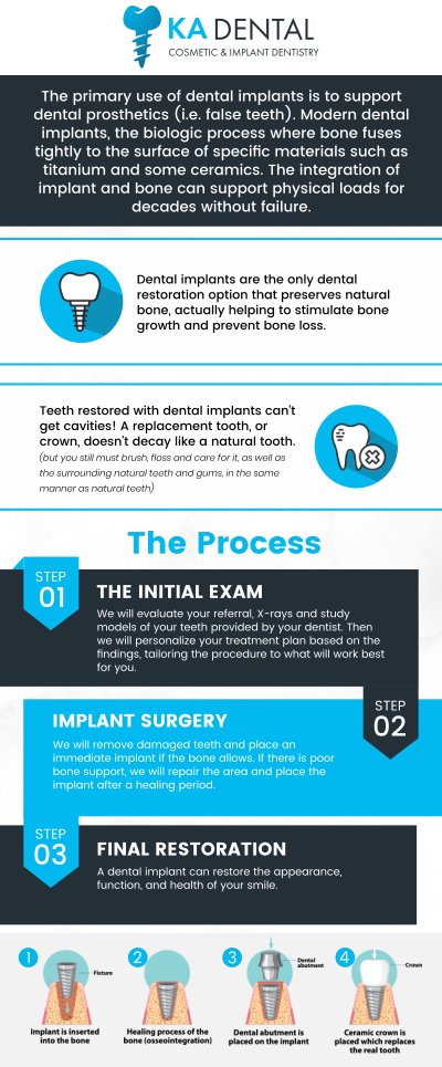 Dental implants are a durable, long-term solution for replacing missing teeth, offering both a functional and aesthetic improvement. They provide a stable foundation for replacement teeth, improving chewing ability and speech. Dr. Aditi Patel, BDS, DDS and Dr. Krunal Patel, BDS, DDS, FICOI ensures proper placement, reduces complications, and leads to a more natural and comfortable result at KA Dental. For more information, contact us or schedule an appointment online. We are conveniently located at 1962 S Military Trl Suite A, West Palm Beach, FL 33415. We serve patients from West Palm Beach FL, Greenacres FL, Lake Worth Beach FL, Lantana FL, Wellington FL, and surrounding cities. Dental implants are a durable, long-term solution for replacing missing teeth, offering both a functional and aesthetic improvement. They provide a stable foundation for replacement teeth, improving chewing ability and speech. Dr. Aditi Patel, BDS, DDS and Dr. Krunal Patel, BDS, DDS, FICOI ensures proper placement, reduces complications, and leads to a more natural and comfortable result at KA Dental. For more information, contact us or schedule an appointment online. We are conveniently located at 1962 S Military Trl Suite A, West Palm Beach, FL 33415. We serve patients from West Palm Beach FL, Greenacres FL, Lake Worth Beach FL, Lantana FL, Wellington FL, and surrounding cities.
