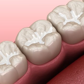 Dental Sealants Near Me in Royal Palm Beach, West Palm Beach, Palm Beach Gardens, and Lantana, FL