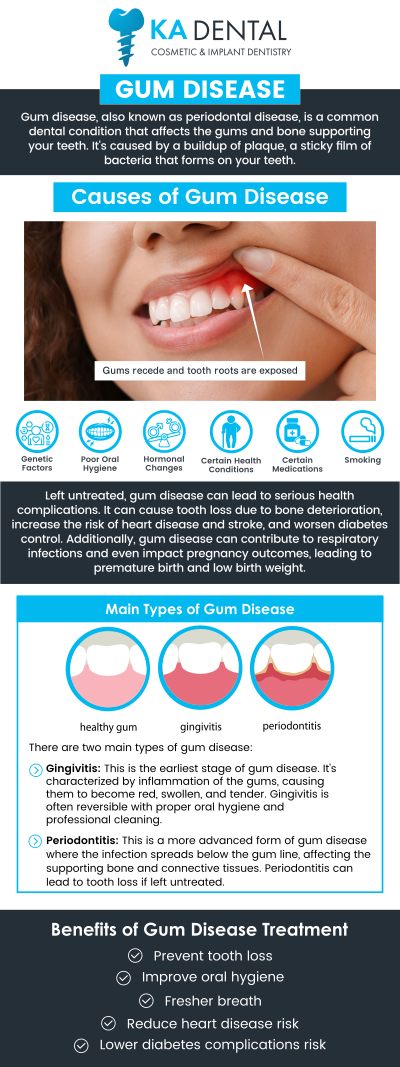 Dr. Aditi Patel, BDS, DDS and Dr. Krunal Patel, BDS, DDS, FICOI are dedicated to providing comprehensive care for patients suffering from gum disease. We offer advanced treatments to reduce inflammation, fight infection, and promote gum healing. For more information, contact us or request an appointment online. We have convenient locations in Royal Palm Beach, West Palm Beach, Palm Beach Gardens, and Lantana, FL. Dr. Aditi Patel, BDS, DDS and Dr. Krunal Patel, BDS, DDS, FICOI are dedicated to providing comprehensive care for patients suffering from gum disease. We offer advanced treatments to reduce inflammation, fight infection, and promote gum healing. For more information, contact us or request an appointment online. We have convenient locations in Royal Palm Beach, West Palm Beach, Palm Beach Gardens, and Lantana, FL.