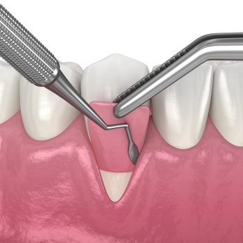 Gum Treatment Near Me in Royal Palm Beach, West Palm Beach, Palm Beach Gardens, and Lantana, FL
