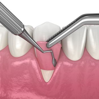 Gum Treatment Near Me in Royal Palm Beach, West Palm Beach, Palm Beach Gardens, and Lantana, FL