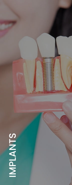 Implants Near Me in Royal Palm Beach, West Palm Beach, Palm Beach Gardens, and Lantana, FL Implants Near Me in Royal Palm Beach, West Palm Beach, Palm Beach Gardens, and Lantana, FL