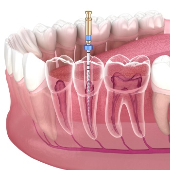 Root Canal Near Me in Royal Palm Beach, West Palm Beach, Palm Beach Gardens, and Lantana, FL