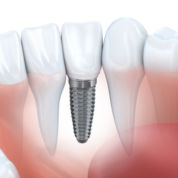 Single Tooth Implant Near Me in Royal Palm Beach, West Palm Beach, Palm Beach Gardens, and Lantana, FL