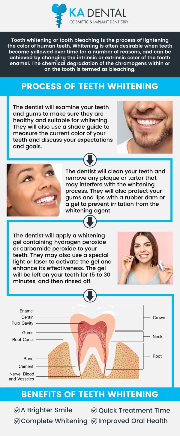 Want a brighter, more confident smile? Teeth whitening is a popular cosmetic dental treatment that can dramatically improve the shade of your teeth, effectively removing stains caused by coffee, tea, wine, and aging. It works by using a safe, peroxide-based gel to penetrate the tooth enamel and break down discoloration, revealing a noticeably whiter and more vibrant smile. Visit Dr. Aditi Patel, BDS, DDS and Dr. Krunal Patel, BDS, DDS, FICOI at KA Dental. For more information, contact us or schedule an appointment online. We are conveniently located at 8776 Lantana Rd, Suite A118, Wellington, FL 33476. Want a brighter, more confident smile? Teeth whitening is a popular cosmetic dental treatment that can dramatically improve the shade of your teeth, effectively removing stains caused by coffee, tea, wine, and aging. It works by using a safe, peroxide-based gel to penetrate the tooth enamel and break down discoloration, revealing a noticeably whiter and more vibrant smile. Visit Dr. Aditi Patel, BDS, DDS and Dr. Krunal Patel, BDS, DDS, FICOI at KA Dental. For more information, contact us or schedule an appointment online. We are conveniently located at 8776 Lantana Rd, Suite A118, Wellington, FL 33476.