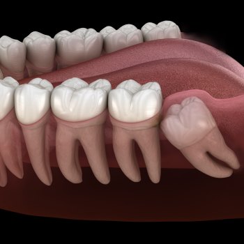 Wisdom Teeth Removal Near Me in Royal Palm Beach, West Palm Beach, Palm Beach Gardens, and Lantana, FL