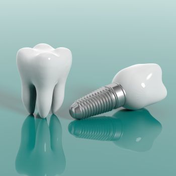 All-on-4 Dental Implants Near Me in Royal Palm Beach, West Palm Beach, Palm Beach Gardens, and Lantana, FL